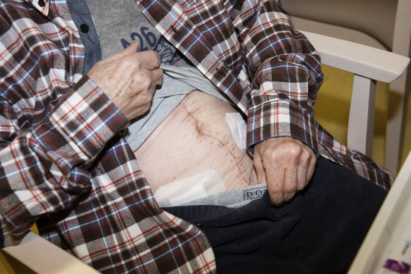 Oudere man toont hechting van wonde op buik.